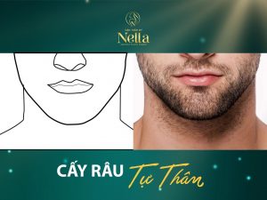 cấy râu tự thân