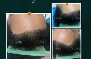 cấy tóc tự thân