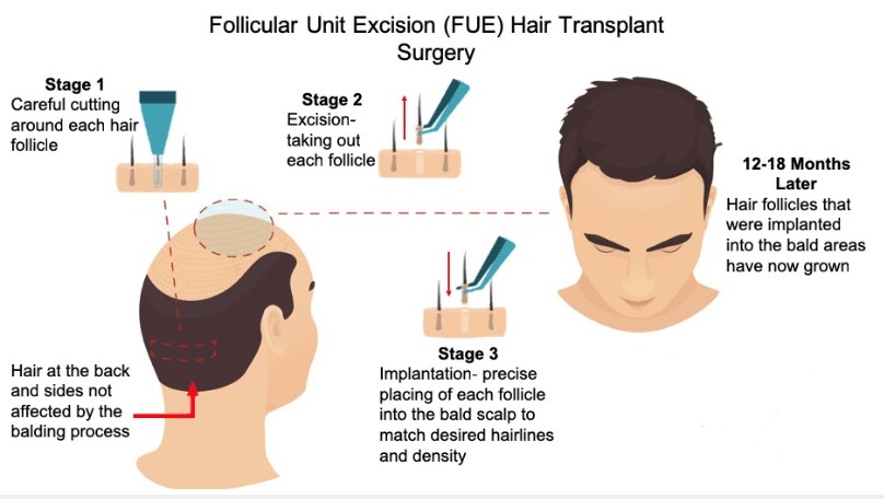 FUE hair transplant vietnam