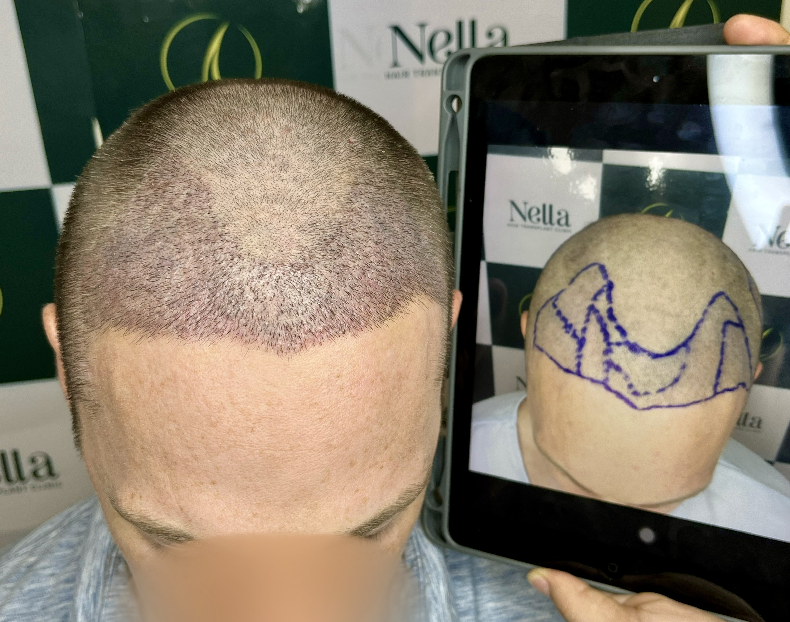 hair transplant vietnam