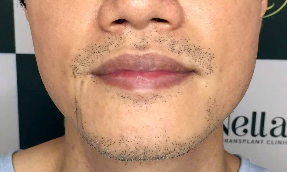 Cấy Râu Tự Thân