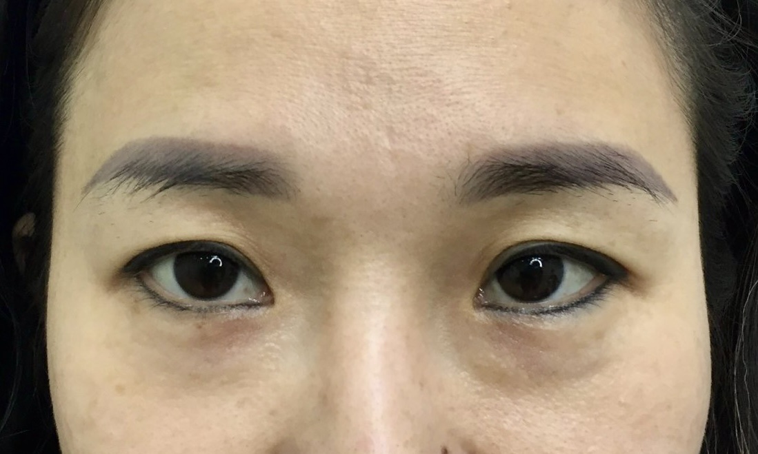 Cấy Lông Mày Tự Thân